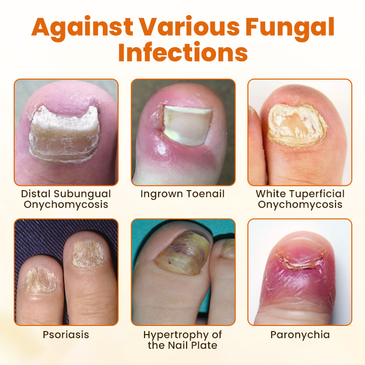 Alcuras® FungiBee Advanced Nail Repair Spray