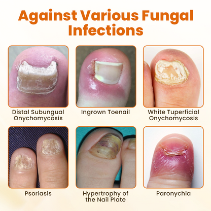 Alcuras® FungiBee Advanced Nail Repair Spray