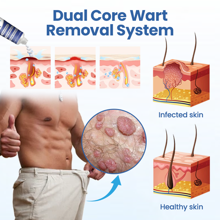 Alcuras® GentX WartRelief Cream