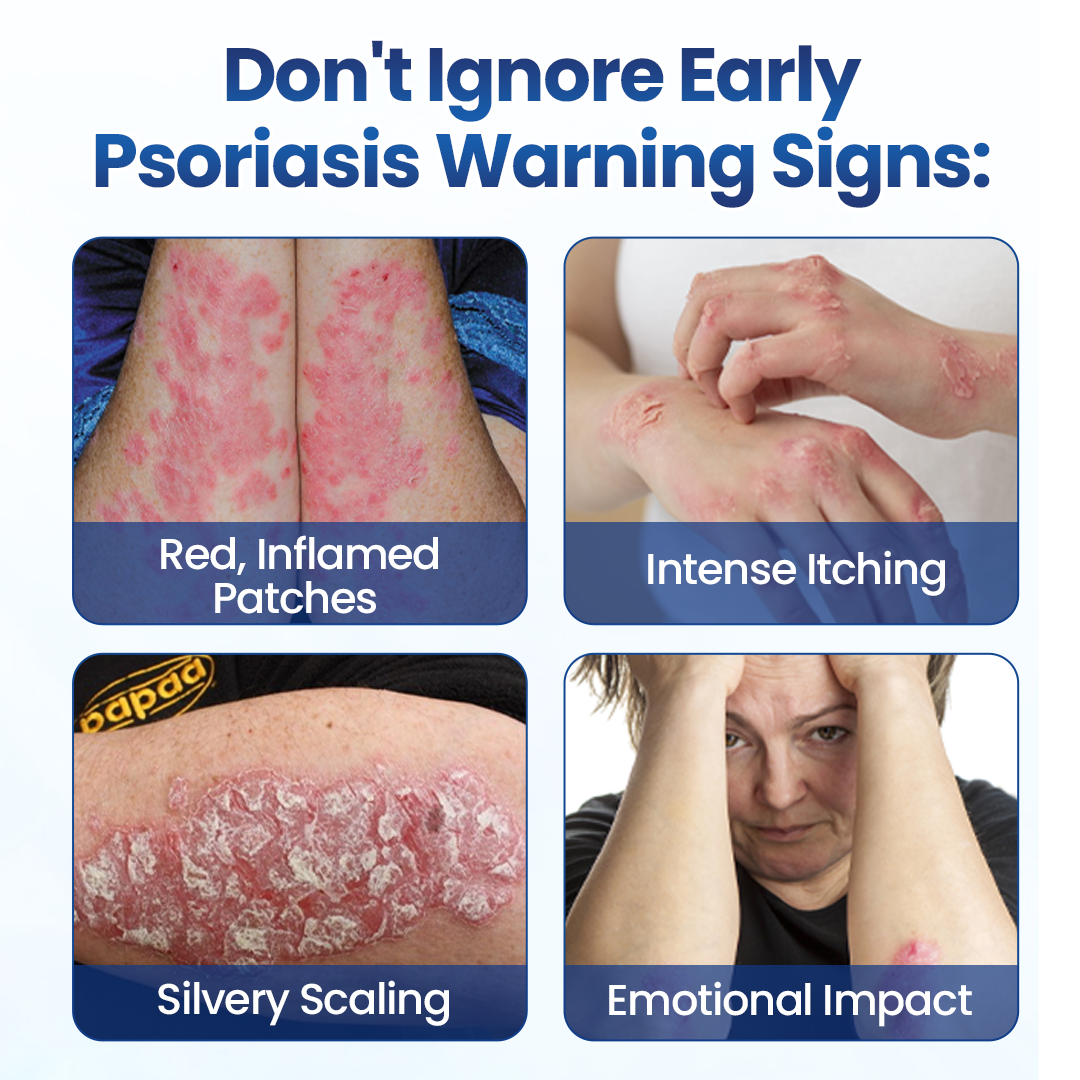 Alcuras® PsoriaMucin No-Rub Itch & Flake Relief Mist